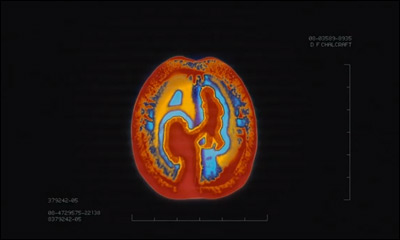 Brain Scan PSA for Alzheimer Society of BC