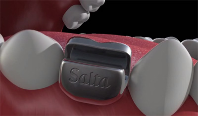 Salta Beer Tooth implant